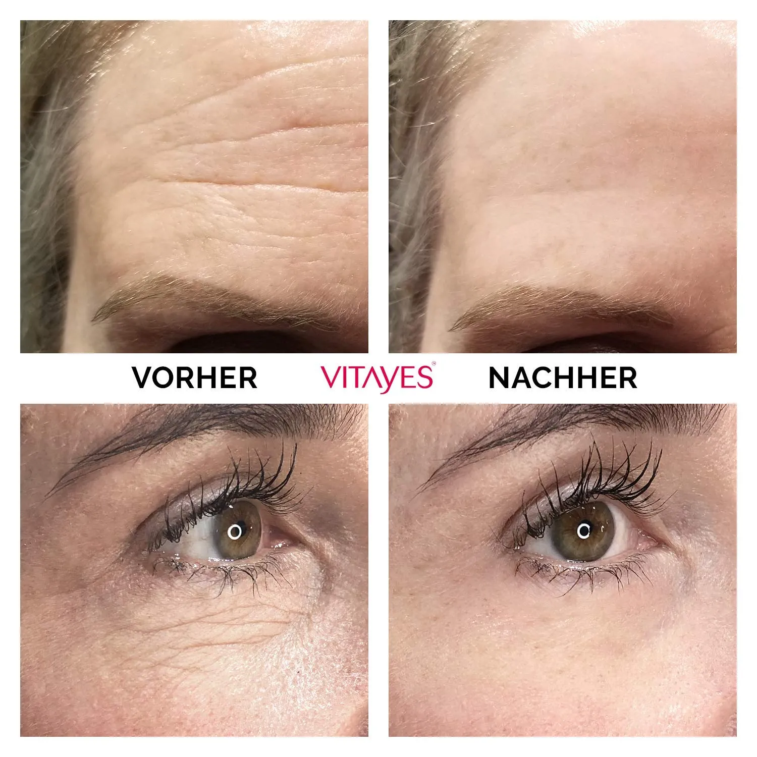 VITAYES Instant Ageback Lifting Cream, Dark Circle Bags Under Eye Remover, Anti Wrinkle and Fine Lines Face Lift Cream 0.24 Oz